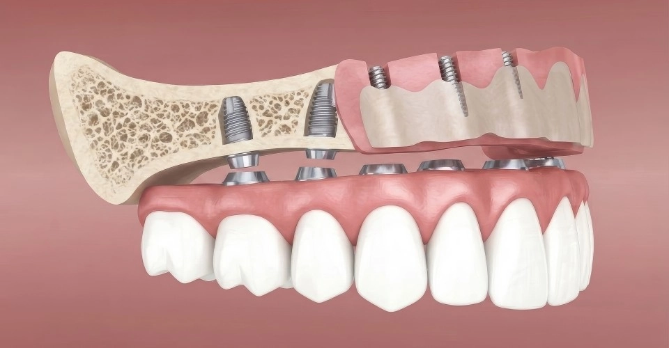All-on-X dental implant treatment planning and bone support