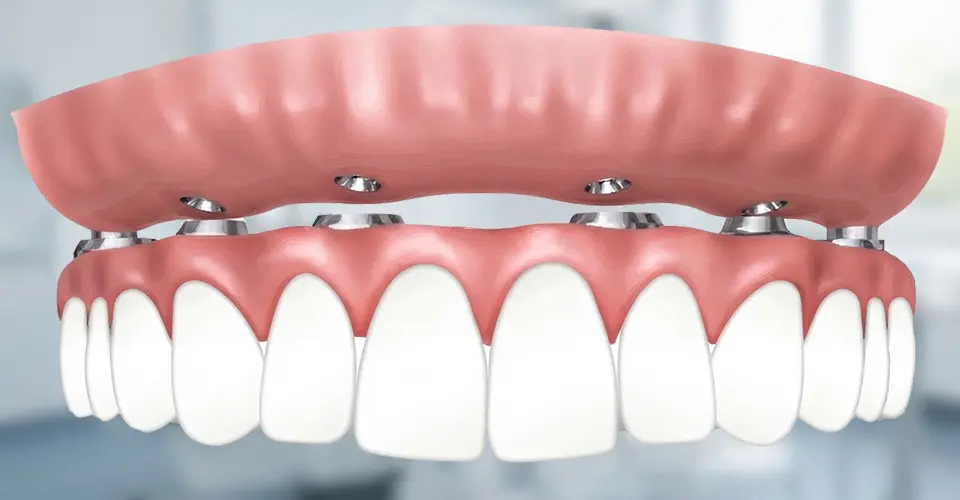 All-on-X dental implants