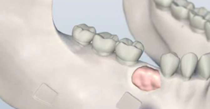 dental implant