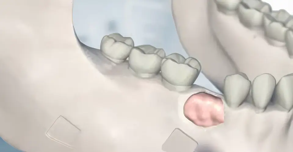 Bone grafting procedure