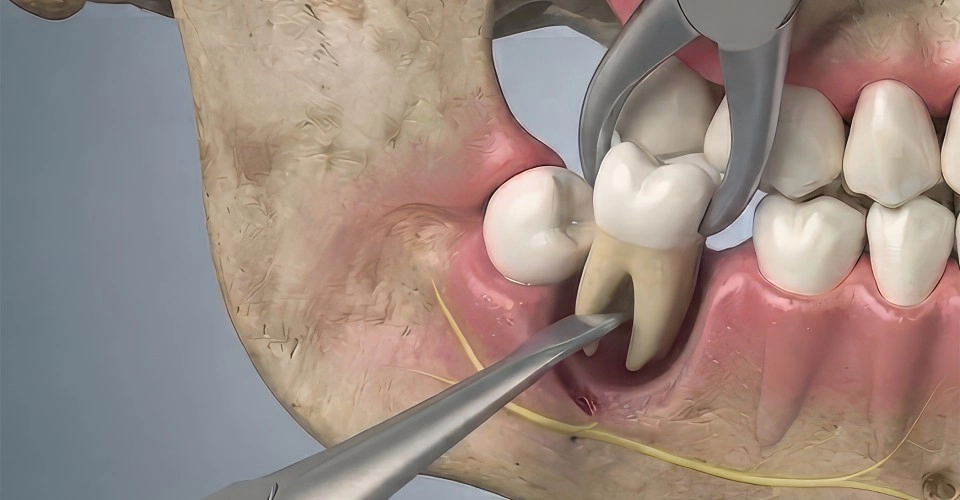 3D dental imaging and evaluation before tooth extraction