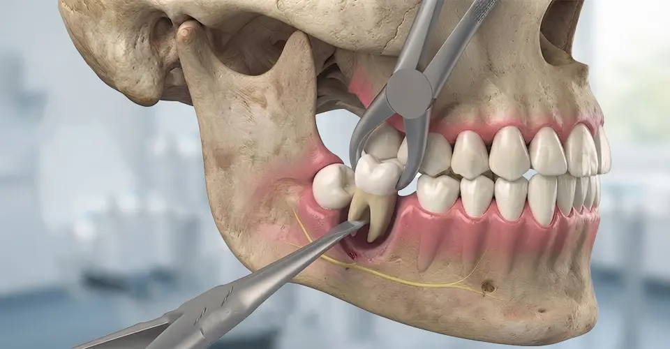 Tooth extraction procedure